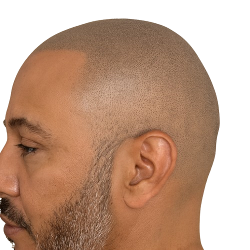 tricopigmentation capillaire Mont de marsan